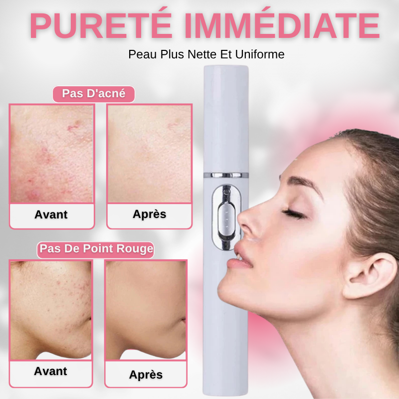 Stylo Laser Anti-acné à Lumière Bleue