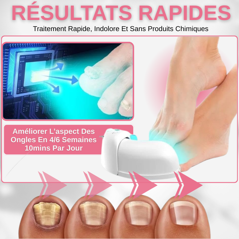 Dispositif de suppression de champignons des ongles au laser