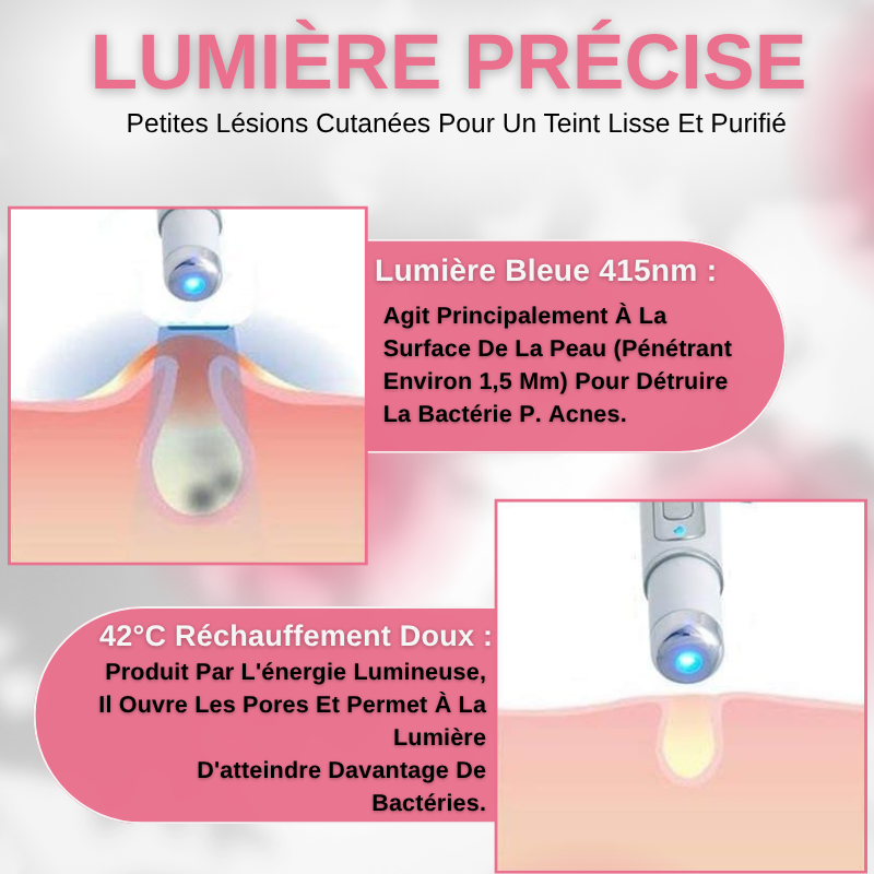 Stylo Laser Anti-acné à Lumière Bleue